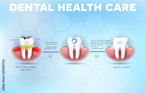 Dental health care tips, how to prevent tooth decay formation and acid attack detailed diagram