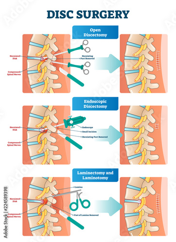 Disc surgery vector illustration. Diagram with back nerves and bones pain.