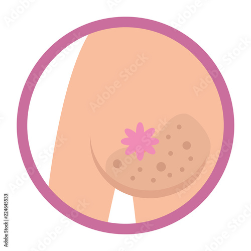 Breast cancer sign