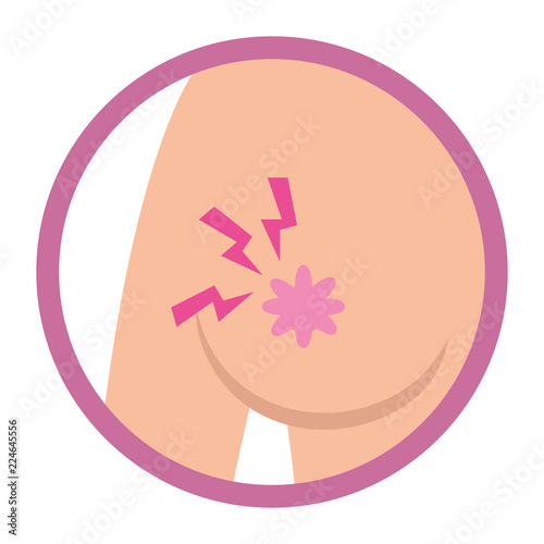 Breast cancer sign
