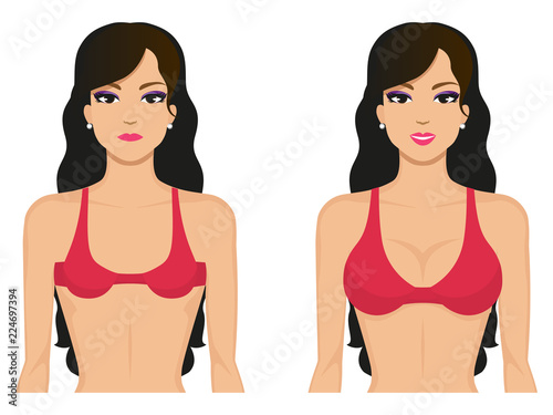 Vector illustration breasts before and after