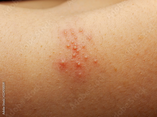 Close up of girl has rash and other nonspecific skin eruption on her shoulders. May be caused by dirt, virus, mold, or bacteria. The doctor is currently diagnosed