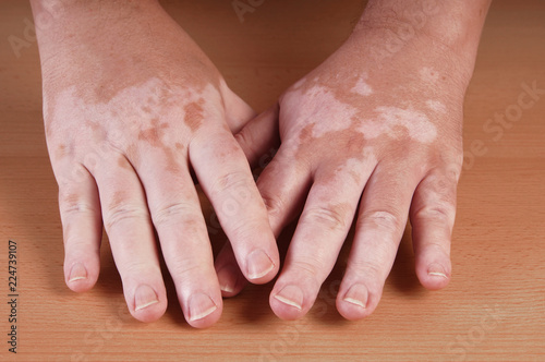 Vitiligo is a medical condition causing depigmentation of patches of skin photo