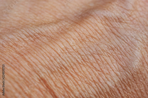 Hand skin with swollen Veins. Human skin and blood vessels in detail.