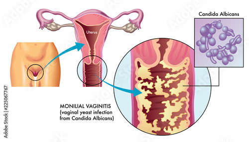 medical illustration of Monilial vaginitis, a vaginal yeast infection caused most commonly by the human fungal Candida albicans