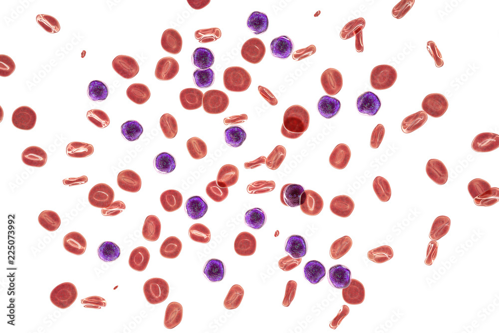 Acute lymphoblastic leukemia Acute lymphoblastic leukemia