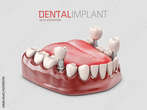 3d illustration of Human Dental implant isolated gray photo