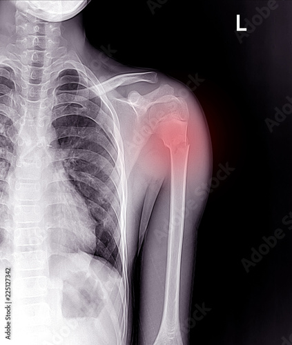 Photo shoulder x-ray show fracture at neck of humerus ( Arm bone ).