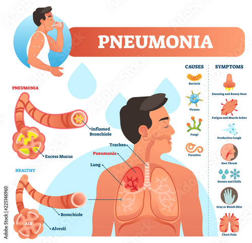 Pneumonia vector illustration. Labeled diagram with causes and symptoms.