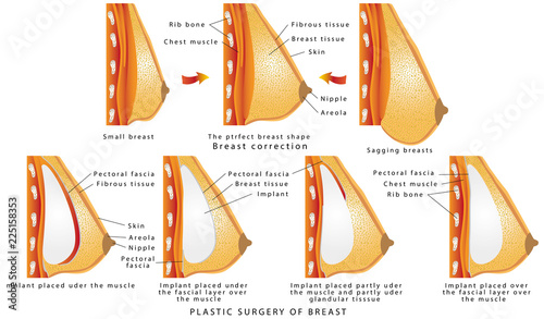 Plastic surgery of breast