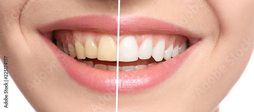 Smiling woman before and after teeth whitening procedure  closeup