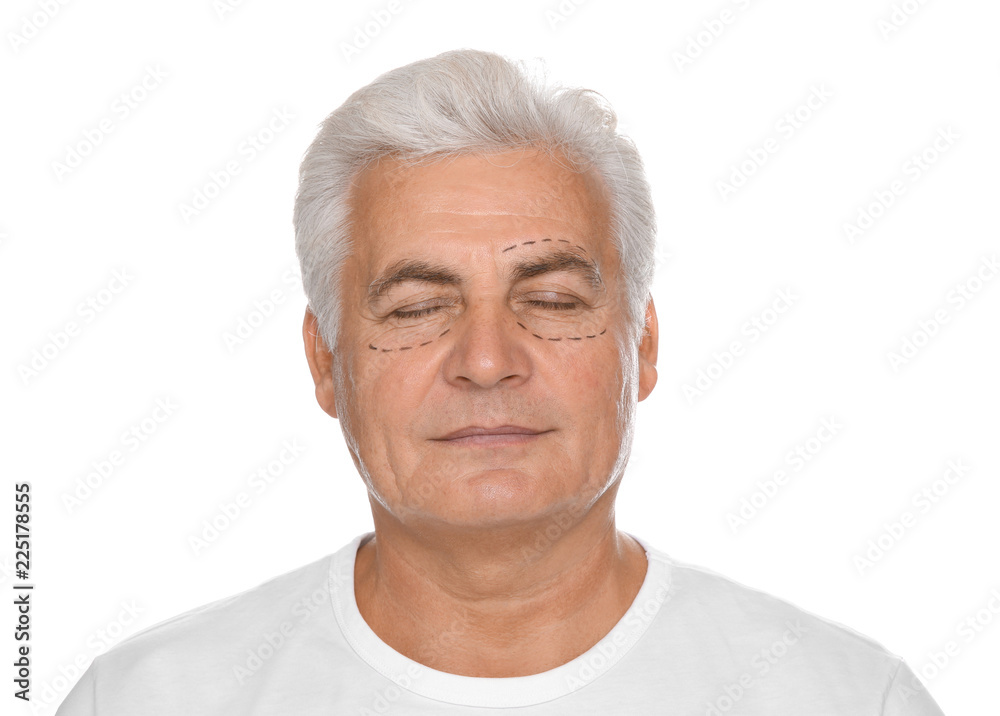 Portrait of senior man with marks on face preparing for cosmetic surgery against white background Portrait of senior man with marks on face preparing for cosmetic surgery against white background