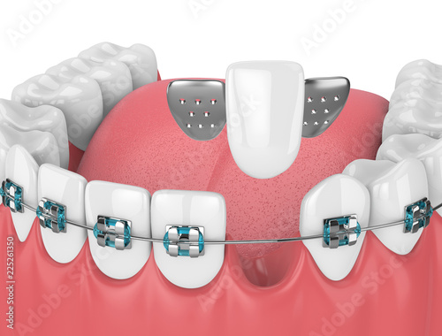 3d render of teeth with orthodontic braces and dental maryland bridge photo