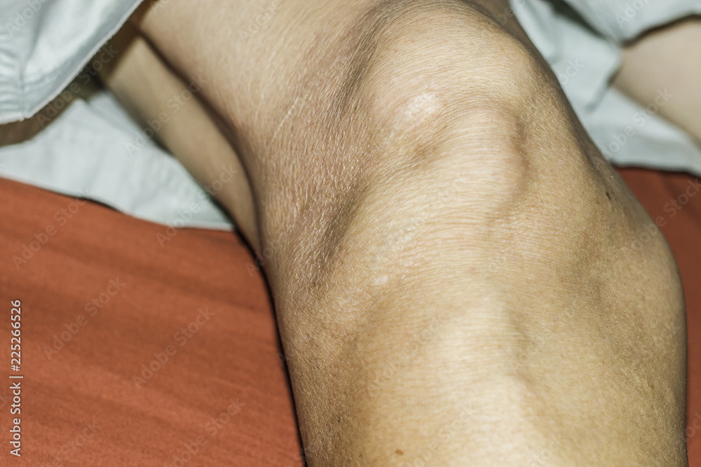Fototapeta premium Severe gout in men suffering from joint pain, bone pain, gout, rheumatoid symptoms, radioactive sickness, ill man concept of male osteoporosis, injured bone, injury, pain, arthritis,arm, foot, knee