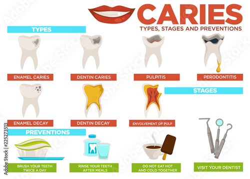 Caries types stages and prevention poster with text vector