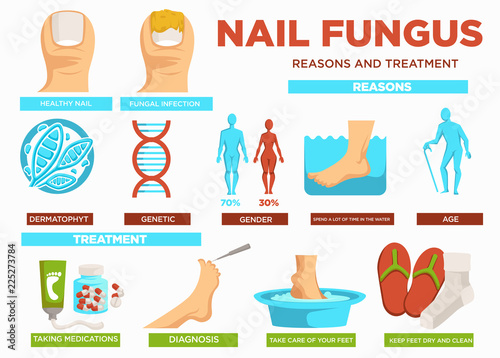 Nail fungus reasons and treatment poster with text vector