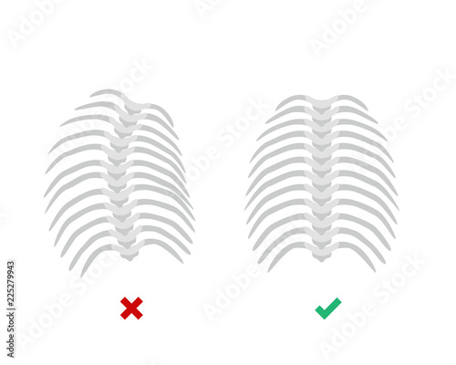 Thoracic Scoliosis on the thoracic spine and straight backbone concept vector illustration in flat design isolated on white background. Scoliosis medical infographic elements