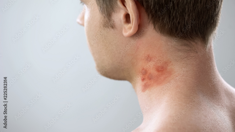 Red spots on male patient neck, of contact dermatitis Stock Photo | Adobe Stock