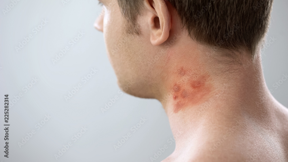 Red spots on male patient neck, bites of insects, allergy, contact dermatitis Red spots on male patient neck, bites of insects, allergy, contact dermatitis