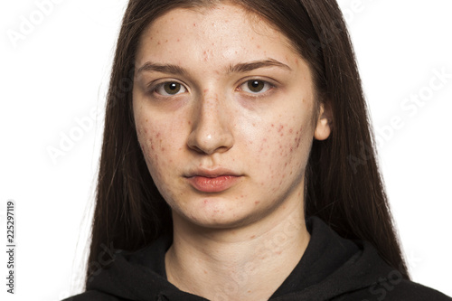 teenage girl with problematic skin on white background