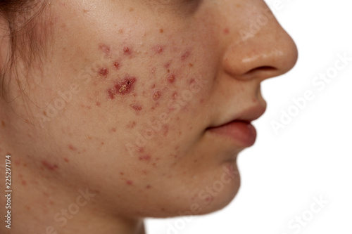 profile closeup of teenage girl with problematic skin on white background