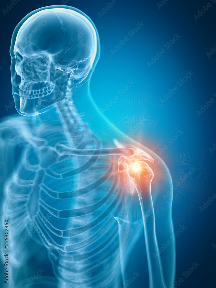 3d rendered medically accurate illustration of a painful shoulder