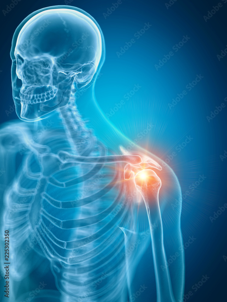 3d rendered medically accurate illustration of a painful shoulder 3d rendered medically accurate illustration of a painful shoulder