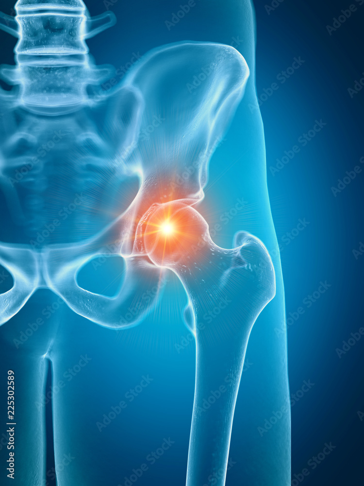3d rendered medically accurate illustration of a painful hip joint
