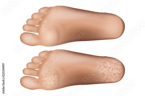 Feet with dry skin before and after treatment. Cracked heel