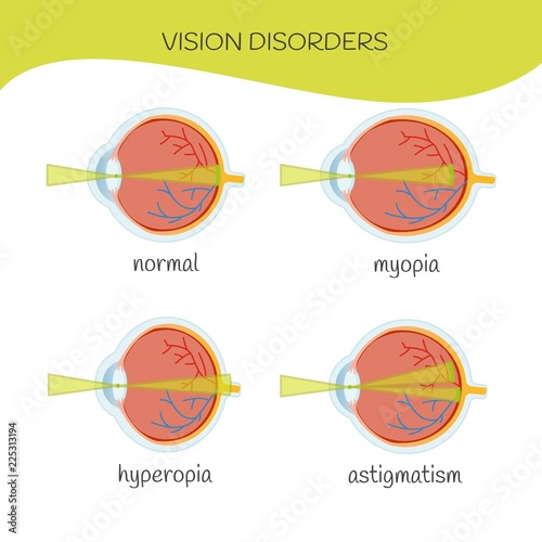 hyperopia myopia vision