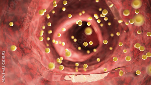 3d rendered medically accurate illustration of colon inflammation caused by gluten photo