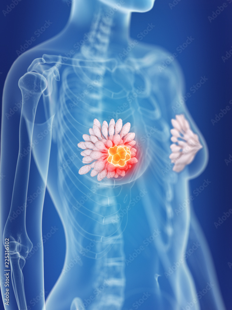 3d rendered medically accurate illustration of a womans mammary glands cancer 3d rendered medically accurate illustration of a womans mammary glands cancer