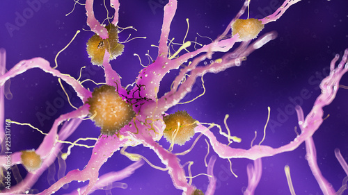 3d rendered medically accurate illustration of amyloid plaques on a alzheimer nerve cell
