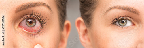 Eyes of girl before and after medical treatment with and without redness