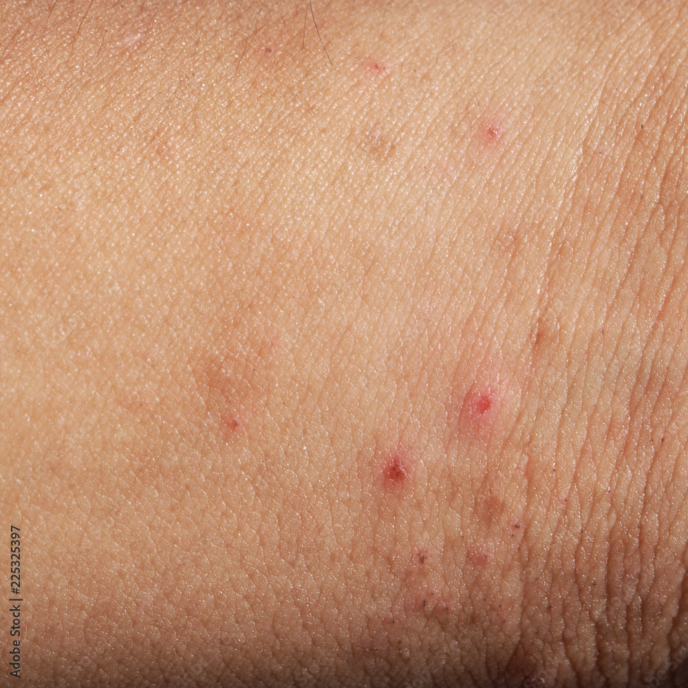 Rash on sensitive skin, skin problem with allergy rash, soft focus Rash on sensitive skin, skin problem with allergy rash, soft focus