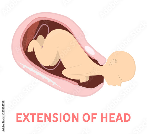 Extension of baby head in vaginal delivery