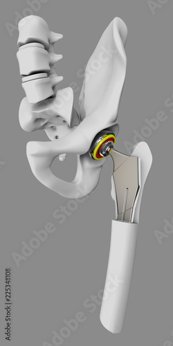 Hip joint replacement, artificial joint isolated gray 3d Illustration photo