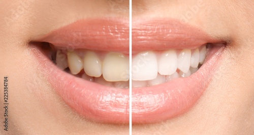 Canvas Print Smiling woman before and after teeth whitening procedure, closeup