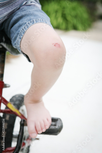 Child's leg with a cut on his knee, bike injury