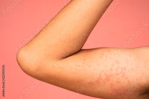 allergic rash on right arm
