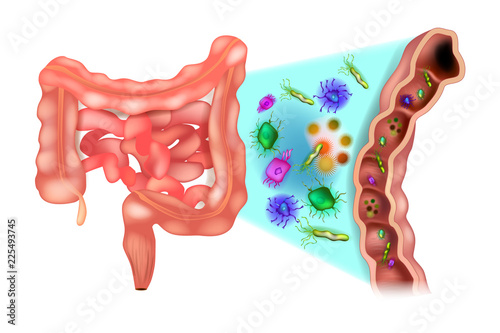 Dysbiosis (also called dysbacteriosis). Dysbacteriosis of the intestine - Colon bacteria. photo