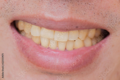 yellow teeth in male from smoke and coffee