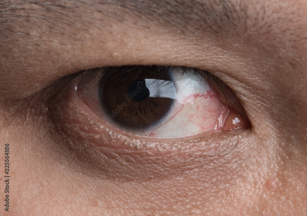 Fototapeta premium Human's red eye conjunctivitis