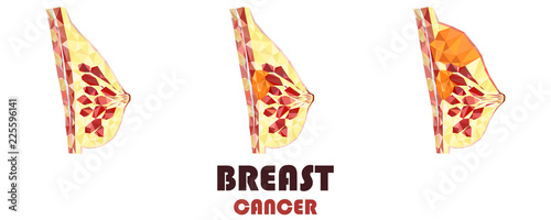 Women breast cancer cross section in low poly. Realistic 3d medical human organ. For medical education, for Clinics, Universities, Schools. Medical book, journal, research. Vector