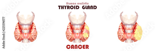 Realistic thyroid gland in low poly. Inflammation cancer Human 3d thyroid, gland, larynx, isthmus, trachea. Vector