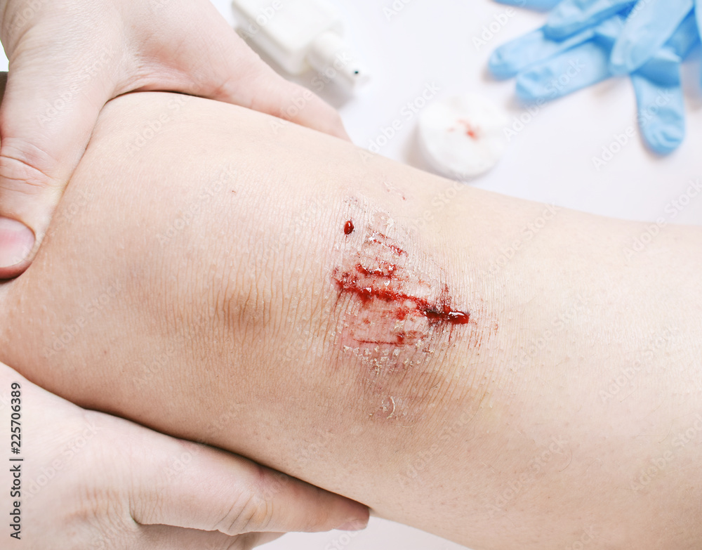 Close-up of bloody gash on knee. Wound treatment with antiseptic Close-up of bloody gash on knee. Wound treatment with antiseptic