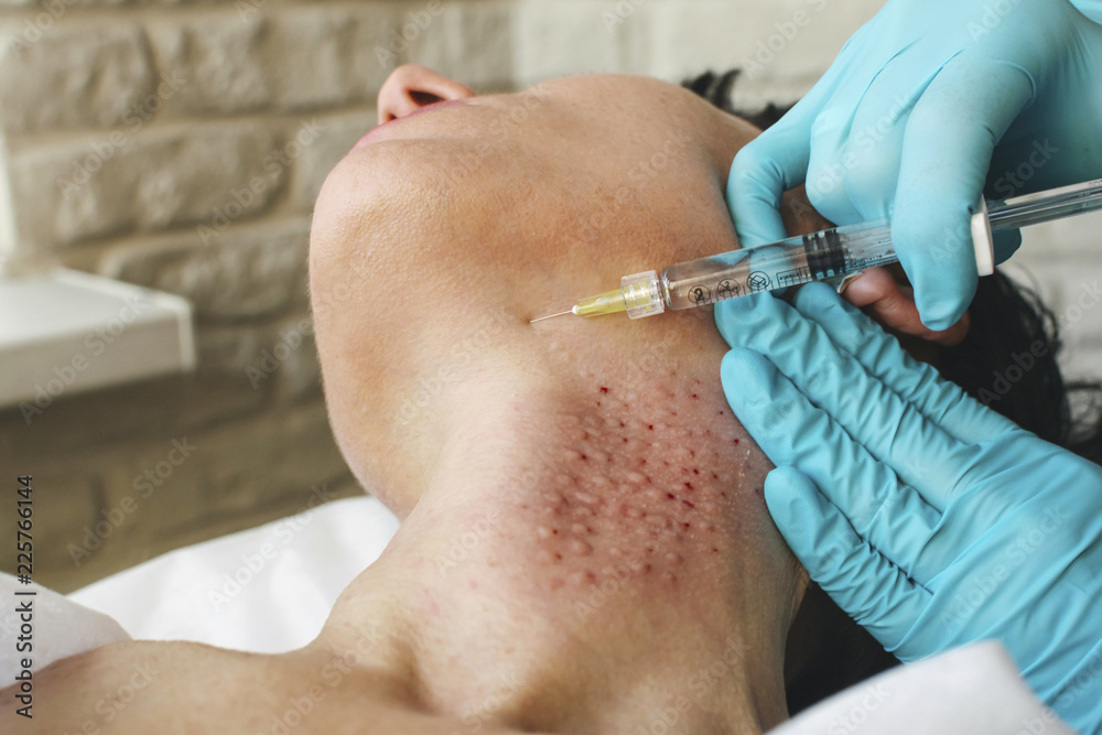 Surgeon hands in gloves injecting rejuvenating liquid into female neck. Beauty concept. Close up Surgeon hands in gloves injecting rejuvenating liquid into female neck. Beauty concept. Close up
