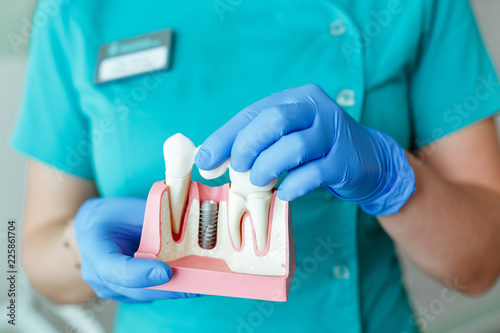 Foto hands of the dentist hold a breadboard model of the tooth with an implant