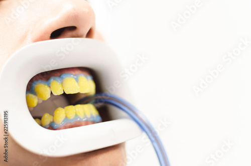 Patient on teeth whitening treatment photo