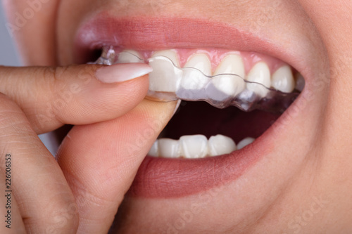 Woman Putting Transparent Aligner In Teeth photo